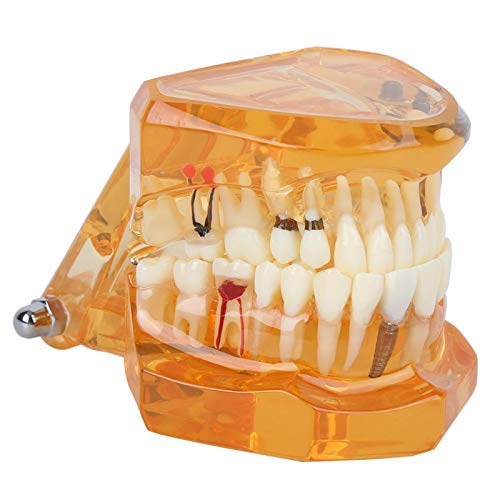 Implantat-Standard-Lehrmodell mit allen abnehmbaren Zähnen, Zahnmodell-Studiendemonstration Transparentes abnehmbares Zahnmodell von Joyzan