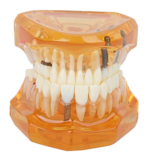 Transparentes Zahnimplantat-Zähne-Modell Zahnmodelle, Standard-Zähne-Modell Dental Oral Typodont-Modell Zahnkrankheit Abnehmbare Studie Lehrzahnmodell für Patientendemonstrationen und Ausbildung von KUIDAMOS