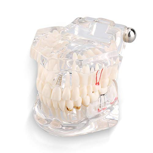Zahnimplantat-Zahnmodell, Zahnzahnmodell, Dental Tooth Model, Zahndemonstrationszahnmodell geeignet für Zahnarztpraxen, juristische Präsentationen und zahnärztliche Schulprogramme von Yosoo